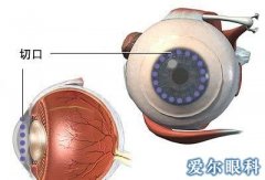 角膜移植手术用于哪些眼病上呢